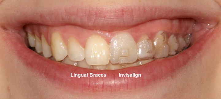 Invisalign (Clear Aligner) Braces Before and After: 3M Clarity